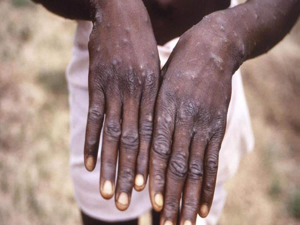 'Possible To Control Monkeypox Outbreak': Ex-FDA Chief Opines As Cases Surge
